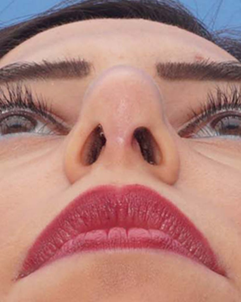 Favorite Revision Rhinoplasty Before & After Gallery - Patient 155140 - Image 7