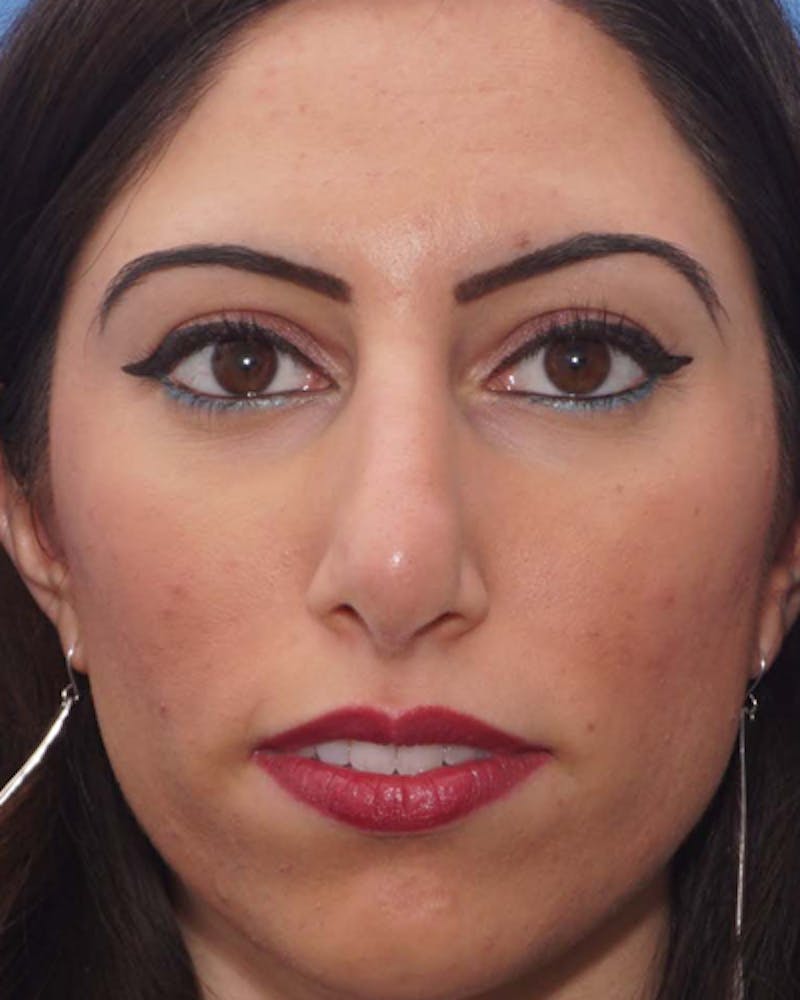 Favorite Revision Rhinoplasty Before & After Gallery - Patient 155140 - Image 5