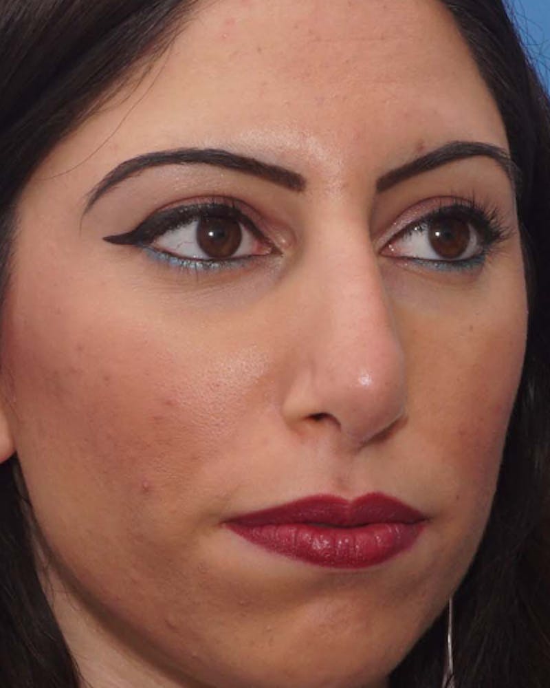 Patient PohtC9R7RFuTvLZzmaNKrg - Revision Rhinoplasty Before & After Photos