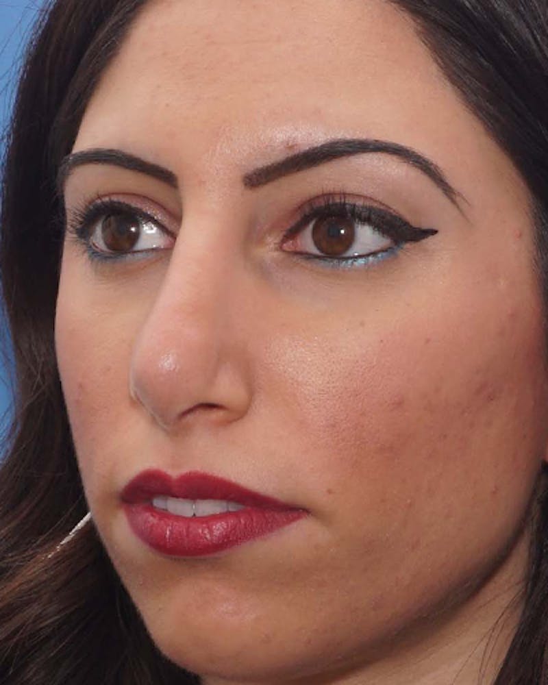 Favorite Revision Rhinoplasty Before & After Gallery - Patient 155140 - Image 3