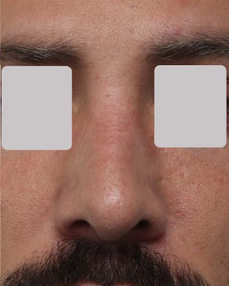 Favorite Revision Rhinoplasty Before & After Gallery - Patient 119491 - Image 4