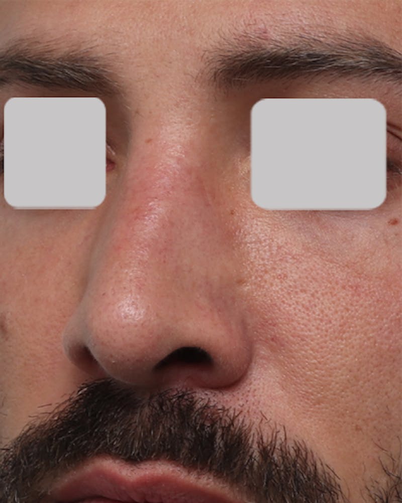 Favorite Revision Rhinoplasty Before & After Gallery - Patient 119491 - Image 6