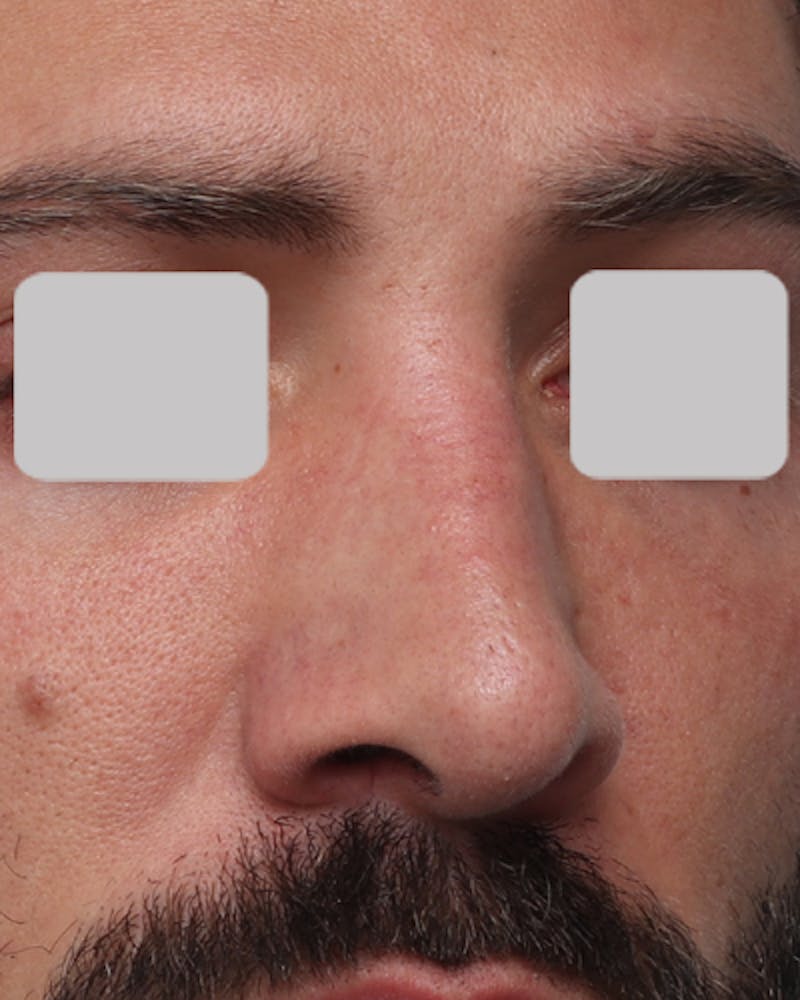 Favorite Revision Rhinoplasty Before & After Gallery - Patient 119491 - Image 8