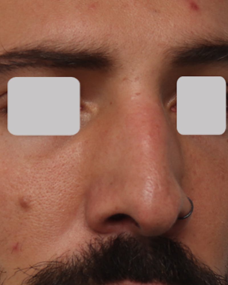 Favorite Revision Rhinoplasty Before & After Gallery - Patient 119491 - Image 7