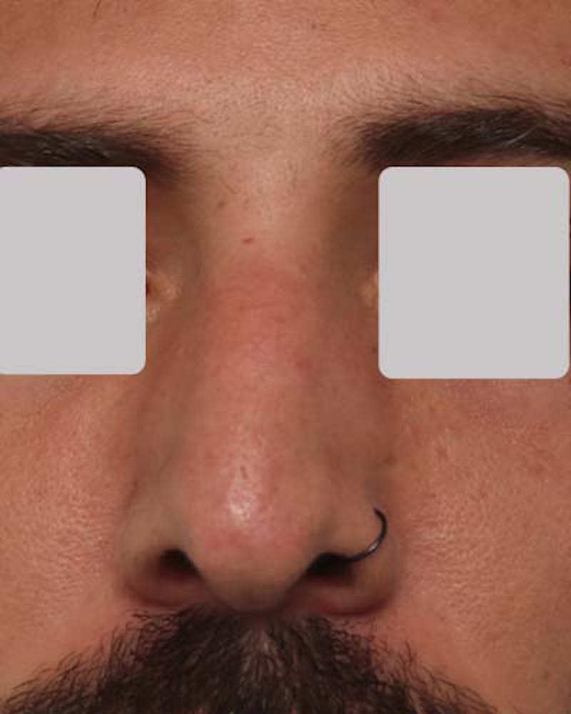 Favorite Revision Rhinoplasty Before & After Gallery - Patient 119491 - Image 3