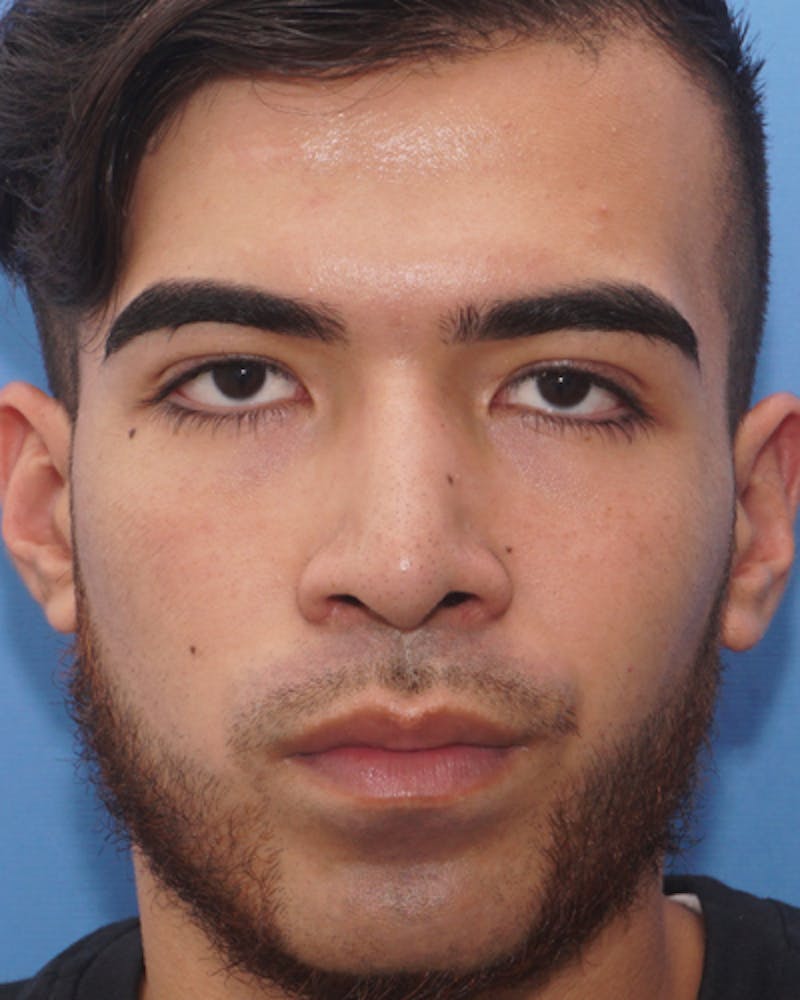 Rhinoplasty  Before & After Gallery - Patient 114663 - Image 4