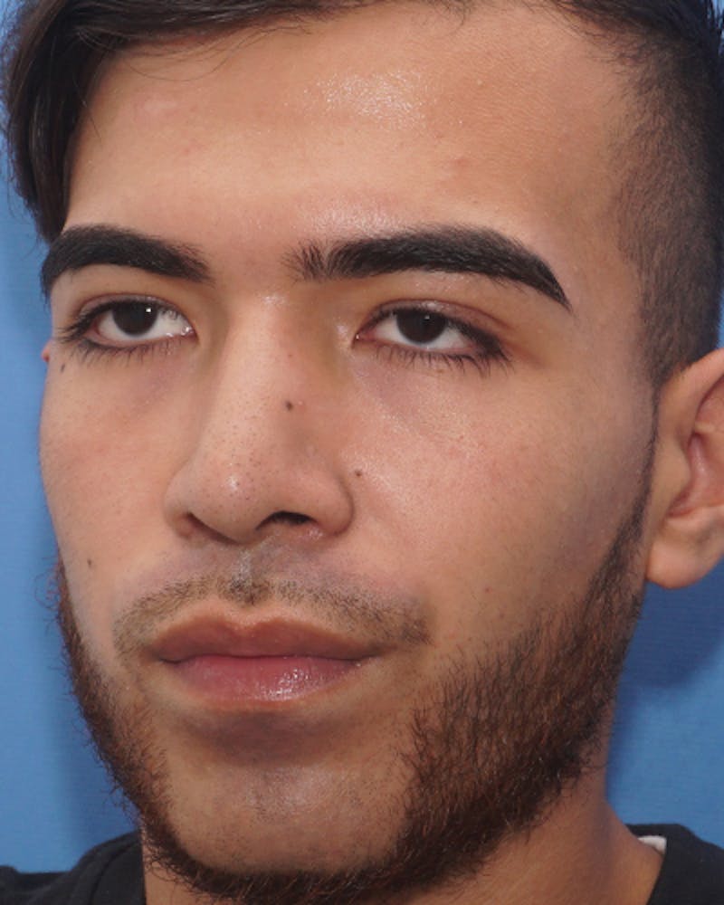 Rhinoplasty  Before & After Gallery - Patient 114663 - Image 6