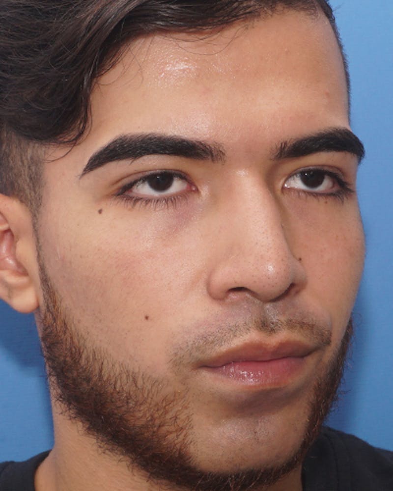 Rhinoplasty  Before & After Gallery - Patient 114663 - Image 8