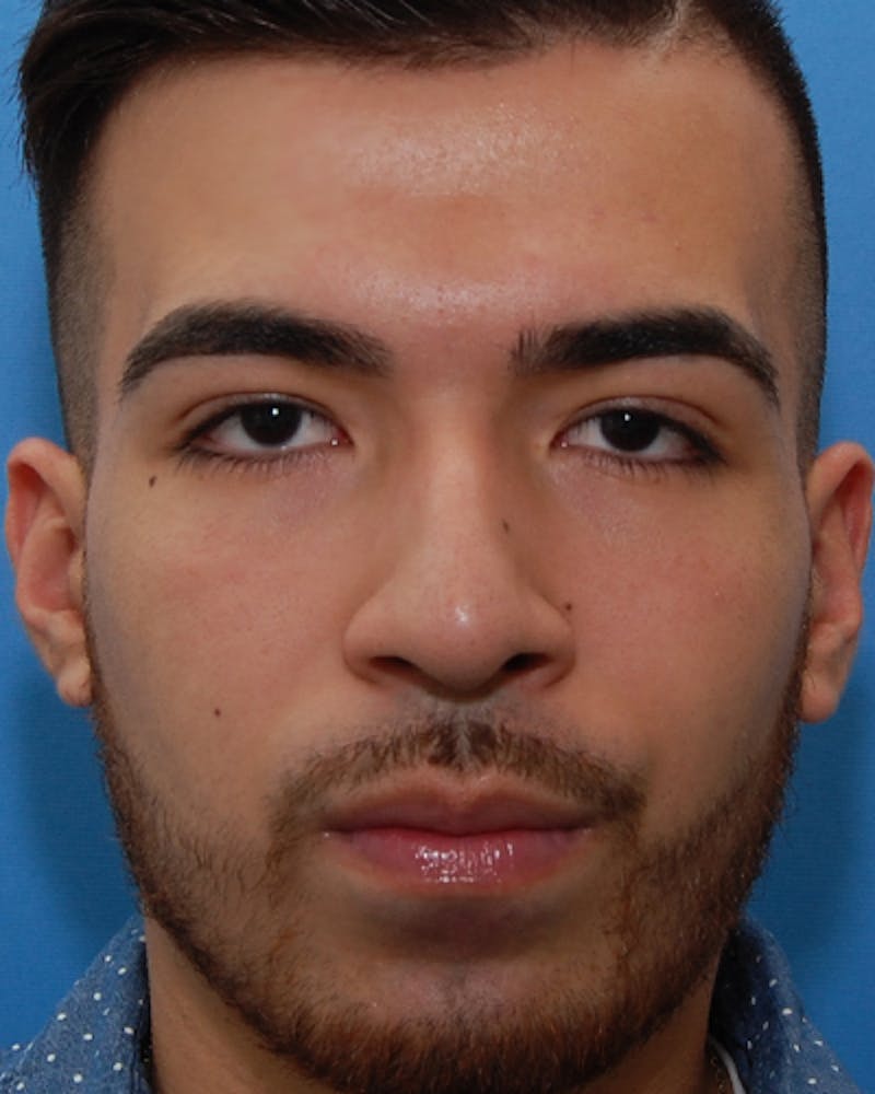 Rhinoplasty  Before & After Gallery - Patient 114663 - Image 3