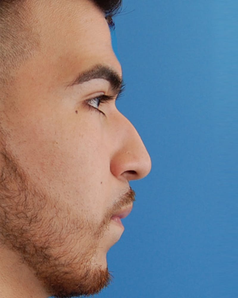 Patient aFyLFvraSqSkRFMzbKzb2g - Male Rhinoplasty Before & After Photos