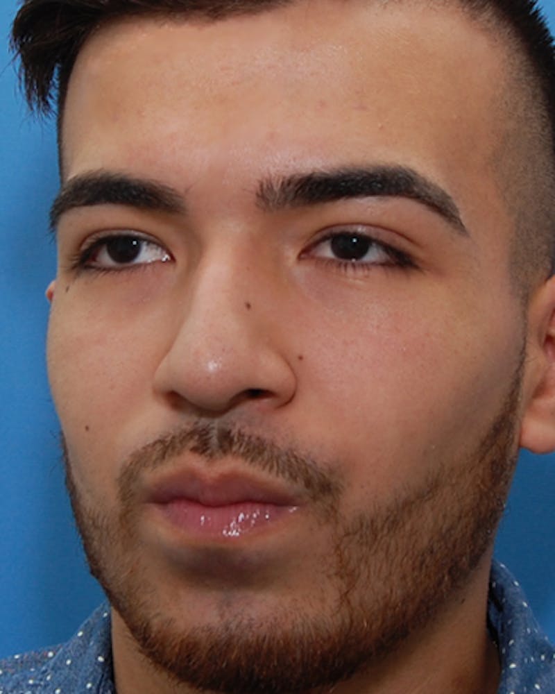 Rhinoplasty  Before & After Gallery - Patient 114663 - Image 5