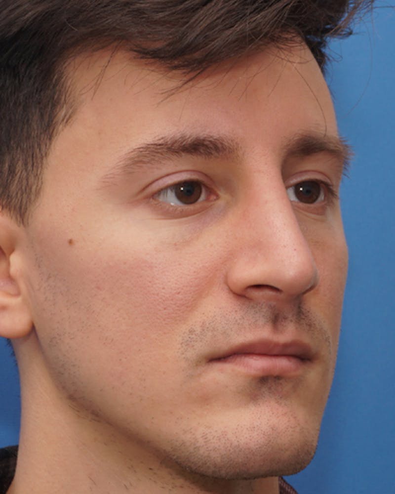 Rhinoplasty  Before & After Gallery - Patient 190588 - Image 6
