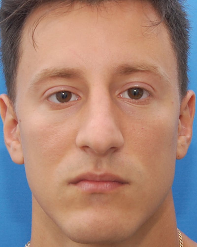 Patient aemg9TmMRISV2j89u7jzTQ - Male Rhinoplasty Before & After Photos