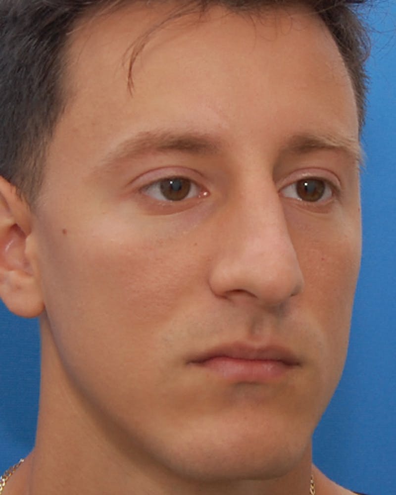 Rhinoplasty  Before & After Gallery - Patient 190588 - Image 5