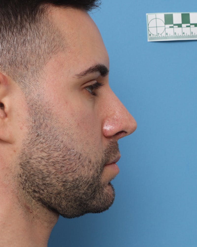 Rhinoplasty  Before & After Gallery - Patient 150593 - Image 6