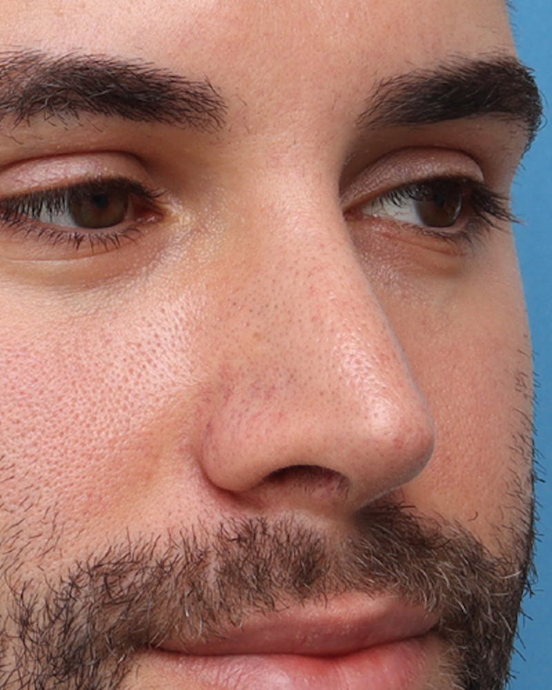 Rhinoplasty  Before & After Gallery - Patient 150593 - Image 4