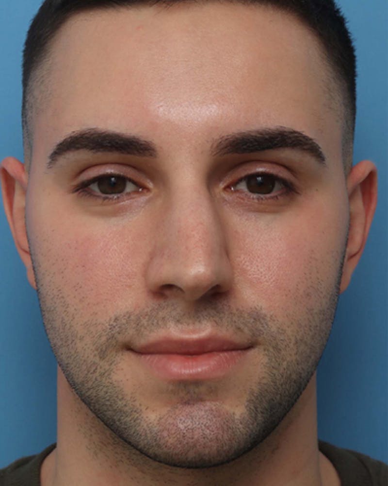 Patient GGeaZ-YXQAuz5W7B3I0PaQ - Before & After Photos