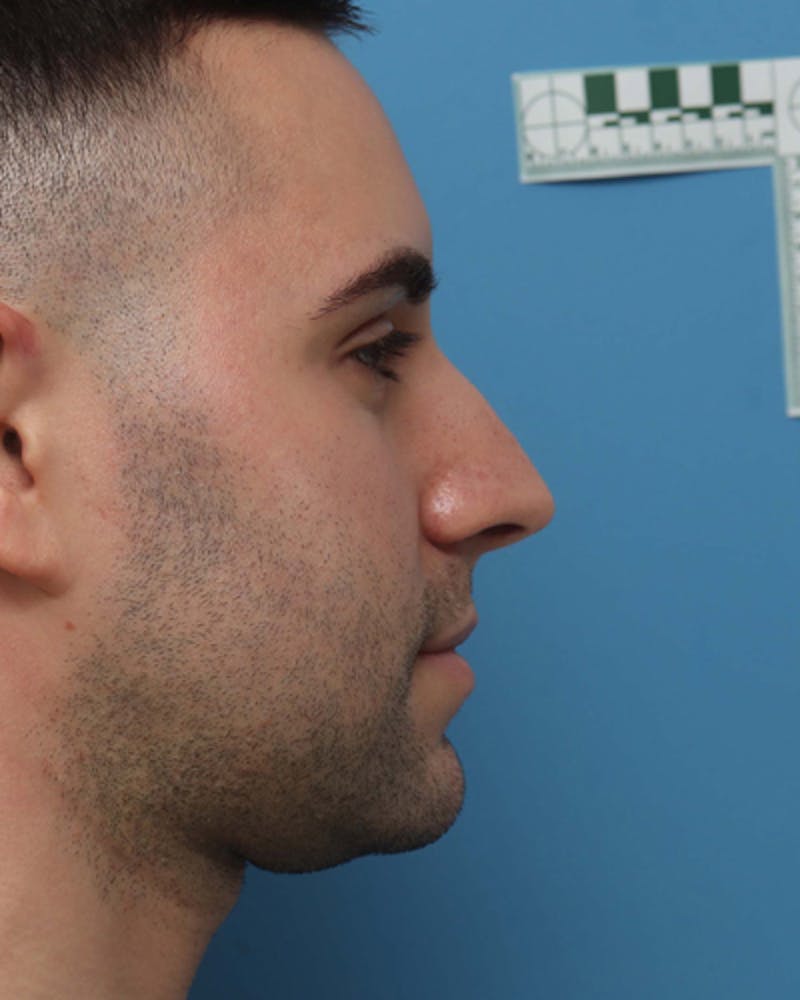 Rhinoplasty  Before & After Gallery - Patient 150593 - Image 5