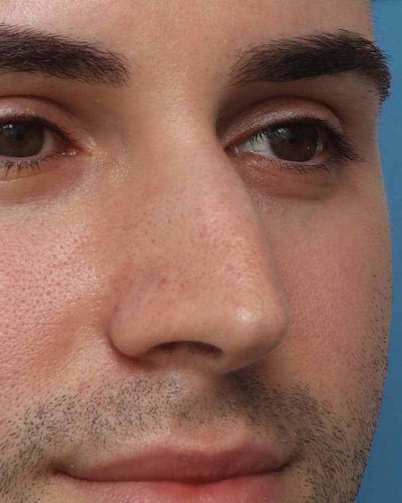 Rhinoplasty  Before & After Gallery - Patient 150593 - Image 3
