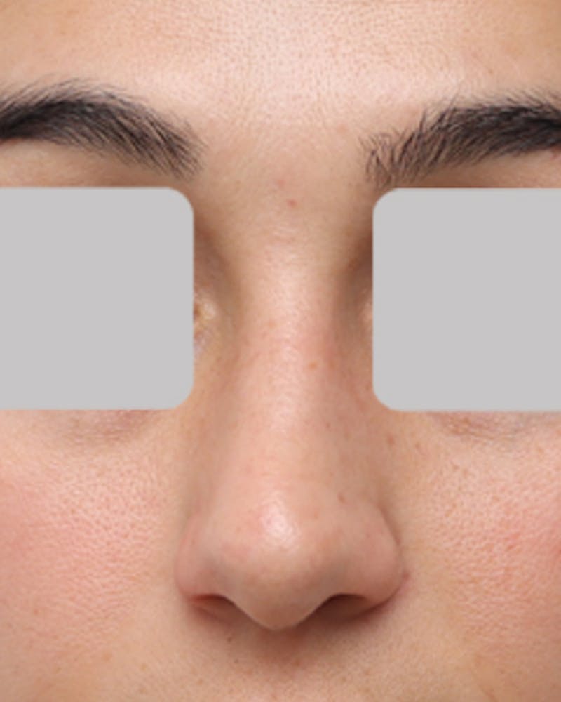 Rhinoplasty  Before & After Gallery - Patient 390427 - Image 3