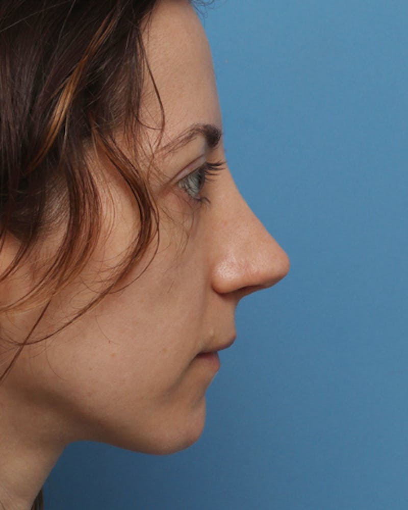 Rhinoplasty  Before & After Gallery - Patient 289173 - Image 4
