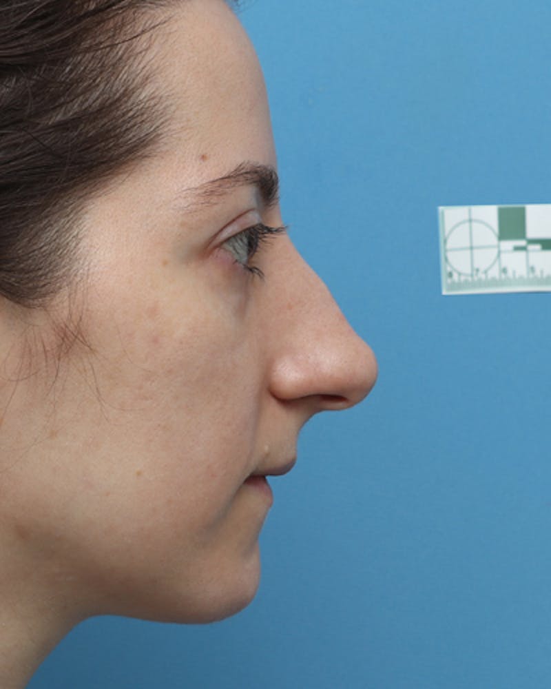 Rhinoplasty  Before & After Gallery - Patient 289173 - Image 3