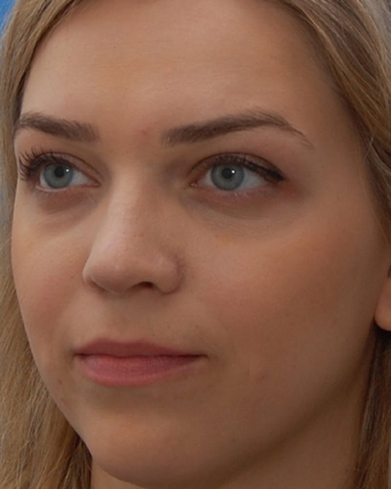 Favorite Revision Rhinoplasty Before & After Gallery - Patient 159568 - Image 6