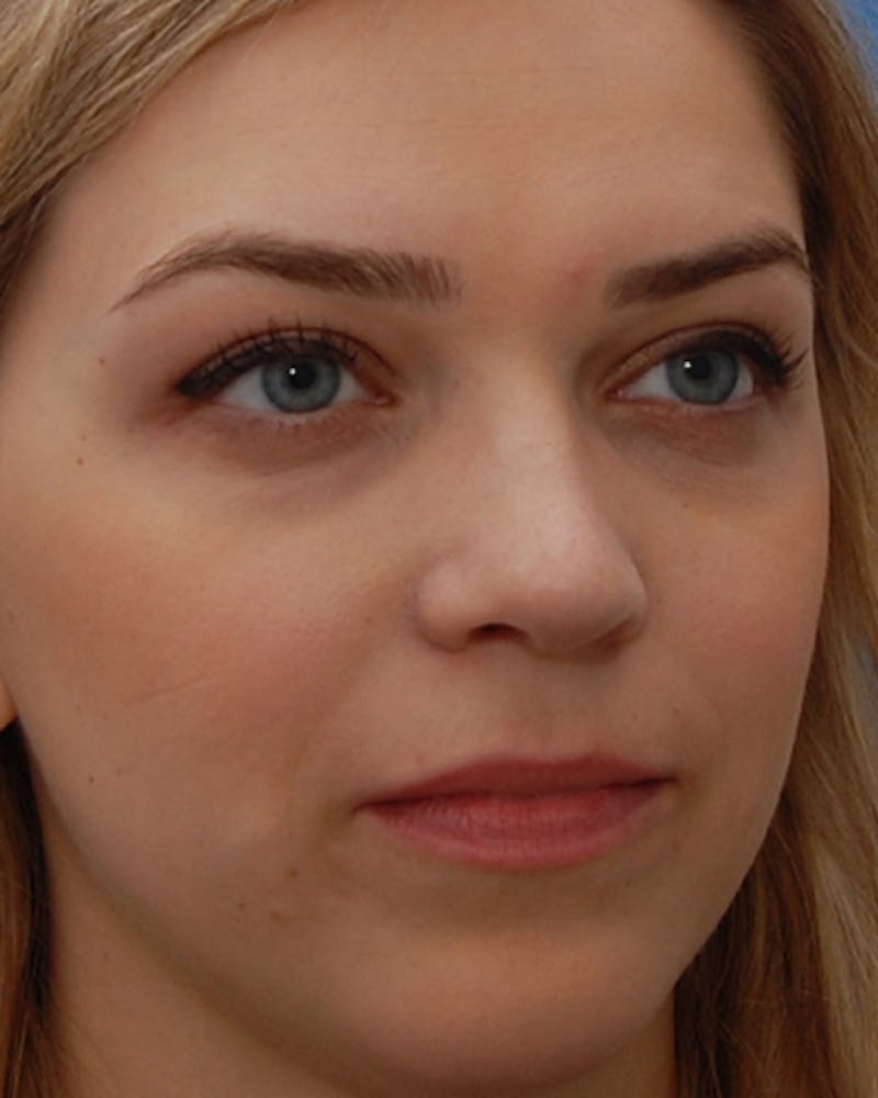 Favorite Revision Rhinoplasty Before & After Gallery - Patient 159568 - Image 8