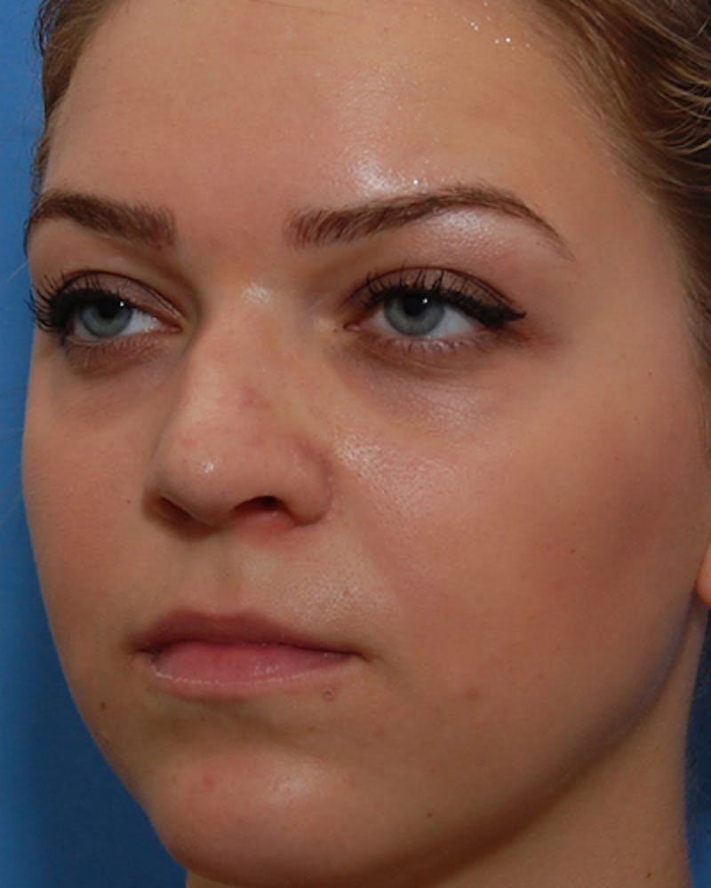 Favorite Revision Rhinoplasty Before & After Gallery - Patient 159568 - Image 5
