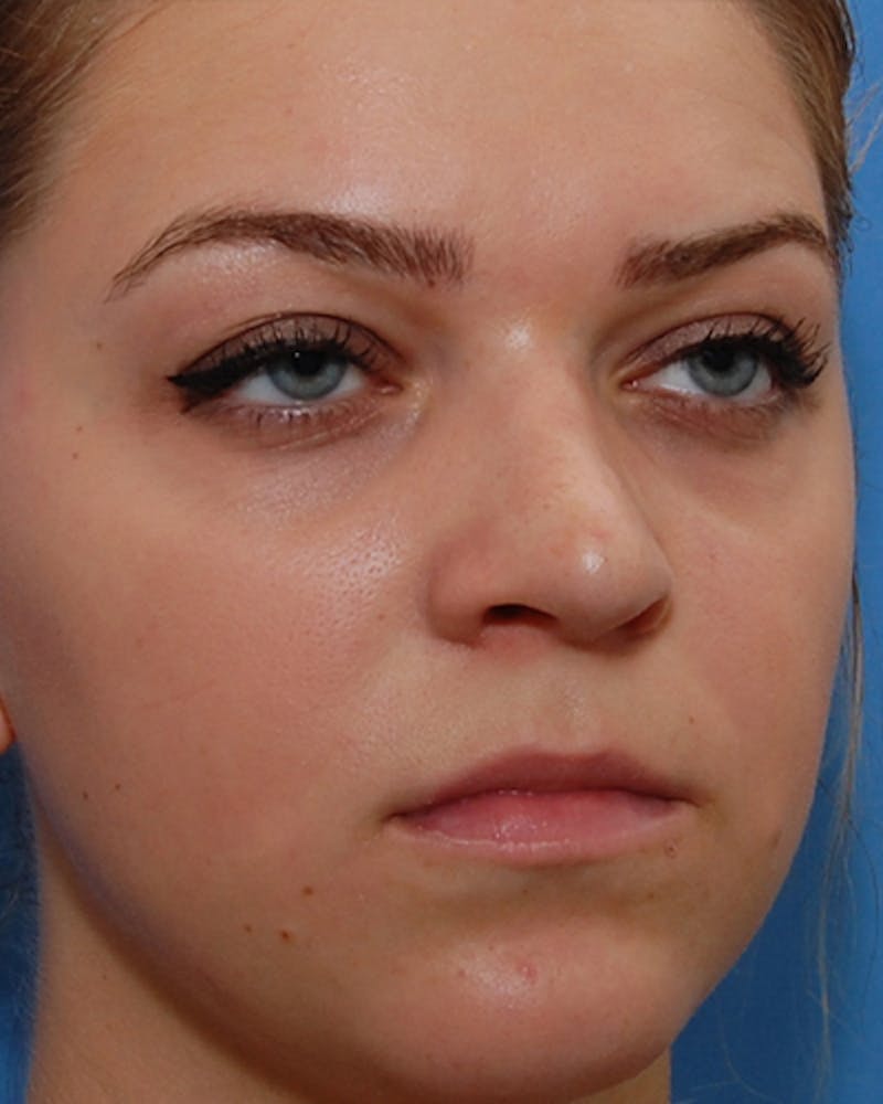 Favorite Revision Rhinoplasty Before & After Gallery - Patient 159568 - Image 7