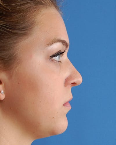 Favorite Revision Rhinoplasty Before & After Gallery - Patient 159568 - Image 1