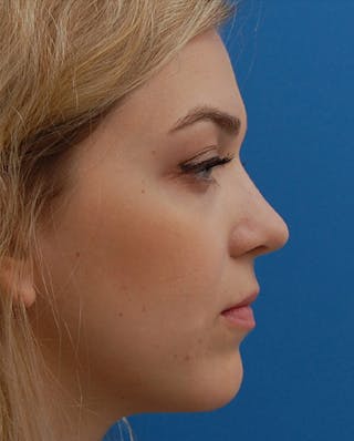 Favorite Revision Rhinoplasty Before & After Gallery - Patient 159568 - Image 2