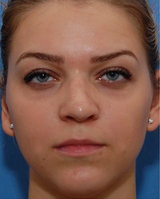 Favorite Revision Rhinoplasty Before & After Gallery - Patient 159568 - Image 4