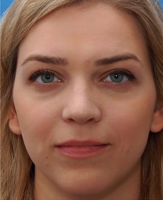 Favorite Revision Rhinoplasty Before & After Gallery - Patient 159568 - Image 4