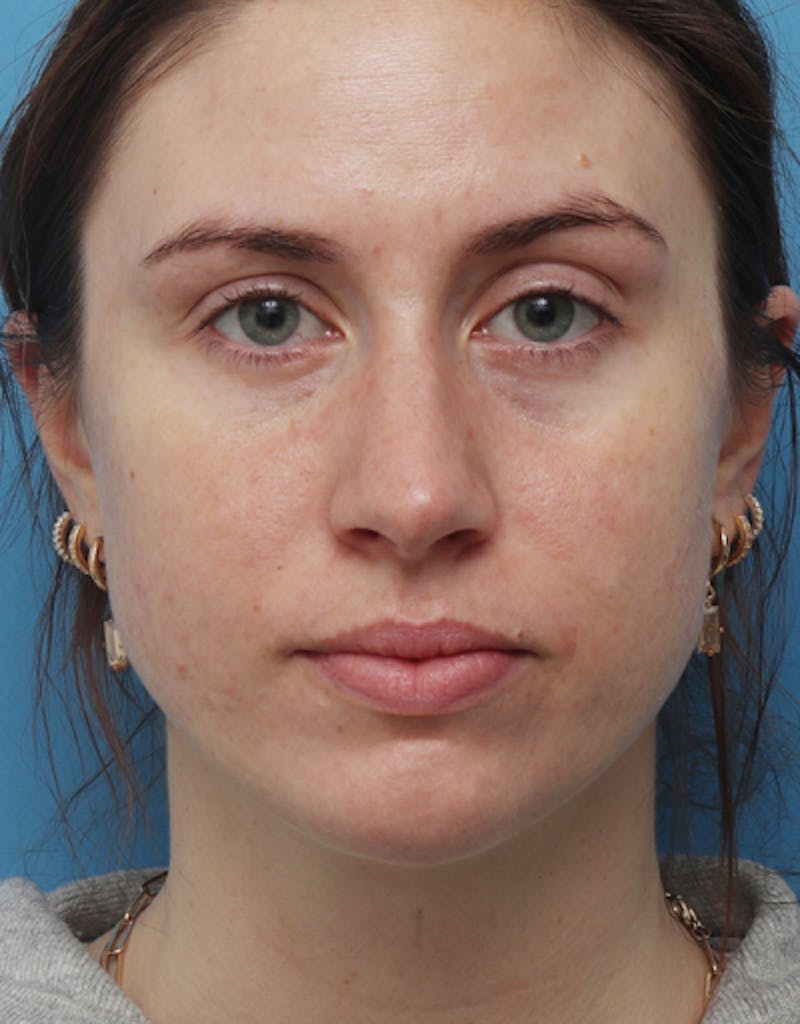 FaceTite Before & After Gallery - Patient 462550 - Image 6