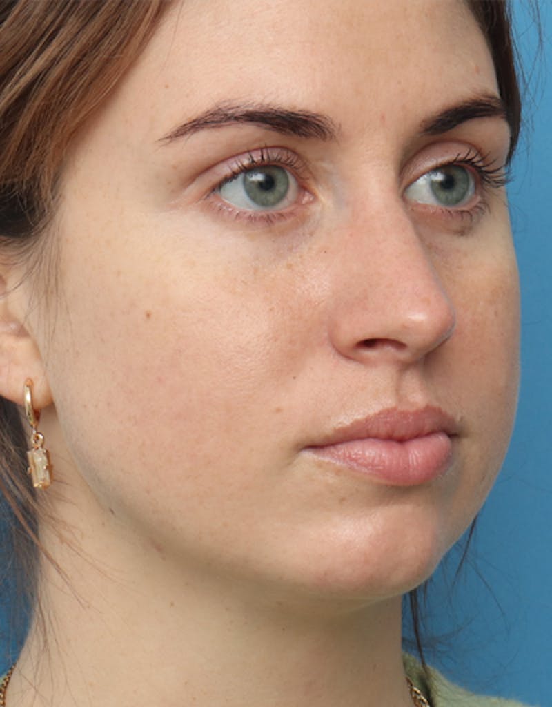 Patient aJDvPsTYRwSui0V3KZZa_A - FaceTite Before & After Photos