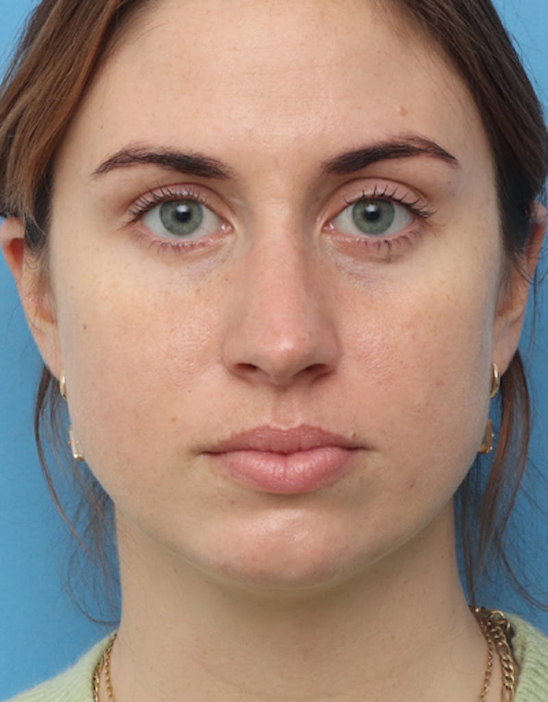 FaceTite Before & After Gallery - Patient 462550 - Image 5
