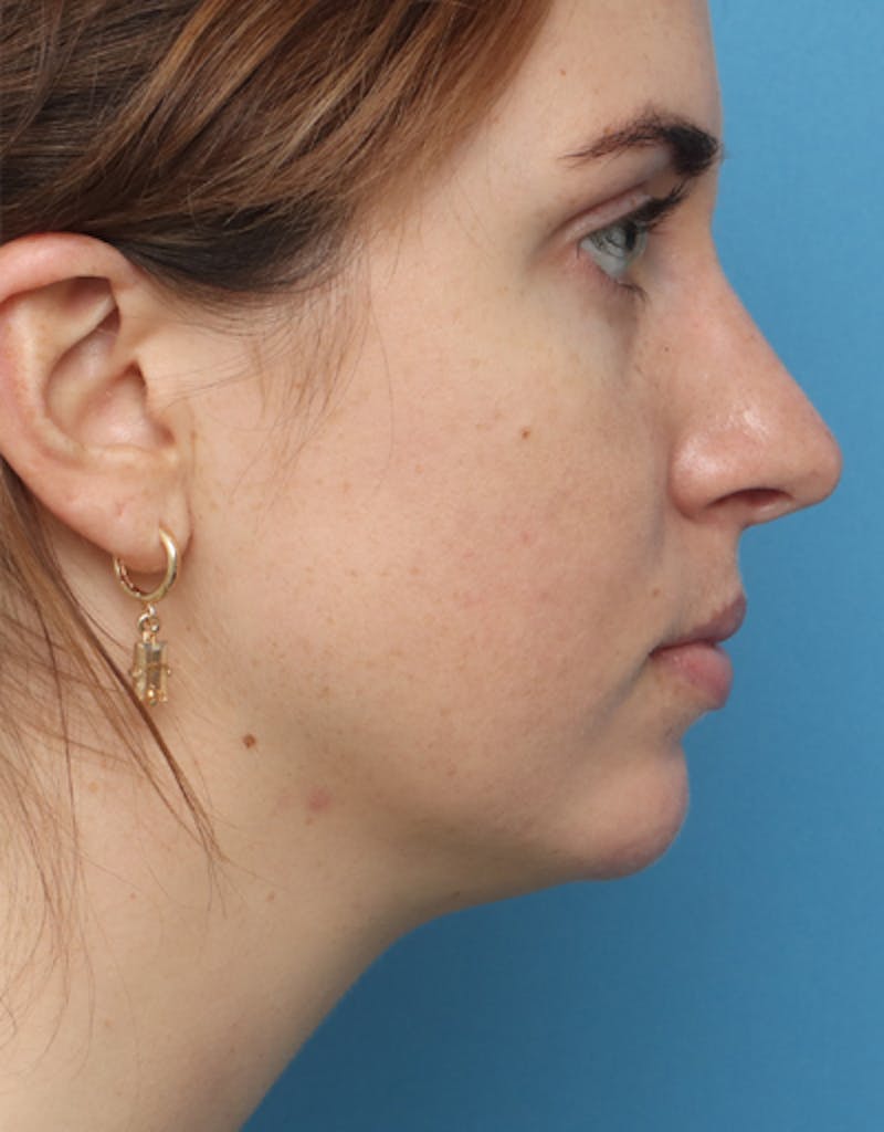 FaceTite Before & After Gallery - Patient 462550 - Image 3
