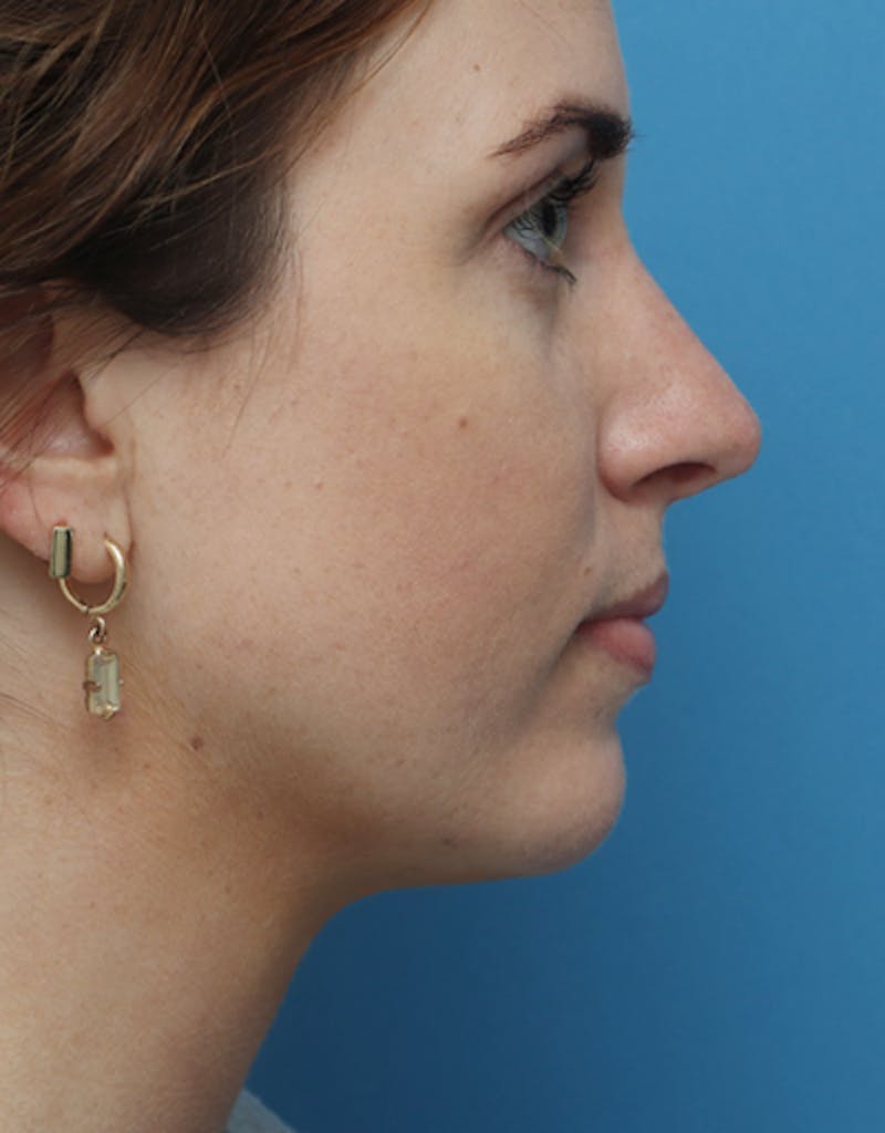 FaceTite Before & After Gallery - Patient 462550 - Image 4