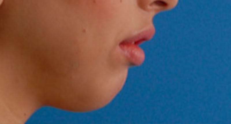 Patient DcA-ne1AThmkpBQ-uQlUUA - Chin Surgery Before & After Photos