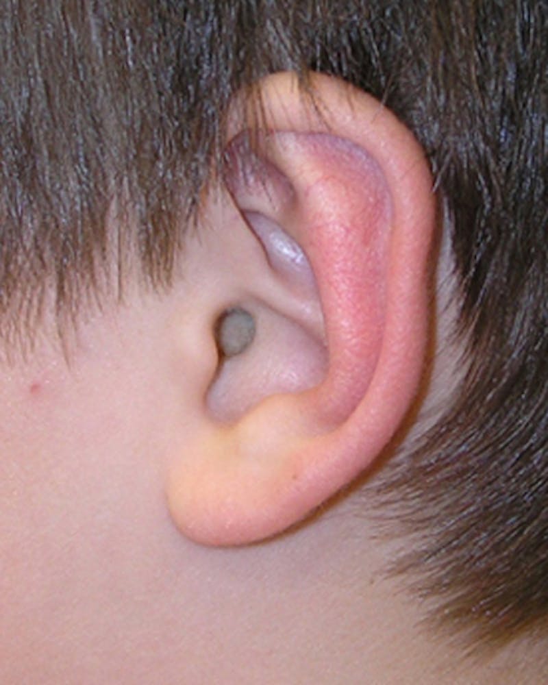 Ear Surgery Before & After Gallery - Patient 225800 - Image 4