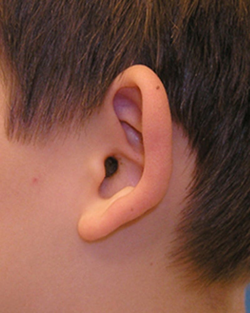 Ear Surgery Before & After Gallery - Patient 225800 - Image 3