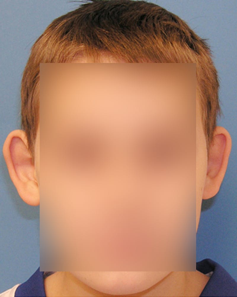 Patient YwGhycSzRvm_dXtlDXISvQ - Ear Surgery (Otoplasty) Before & After Photos