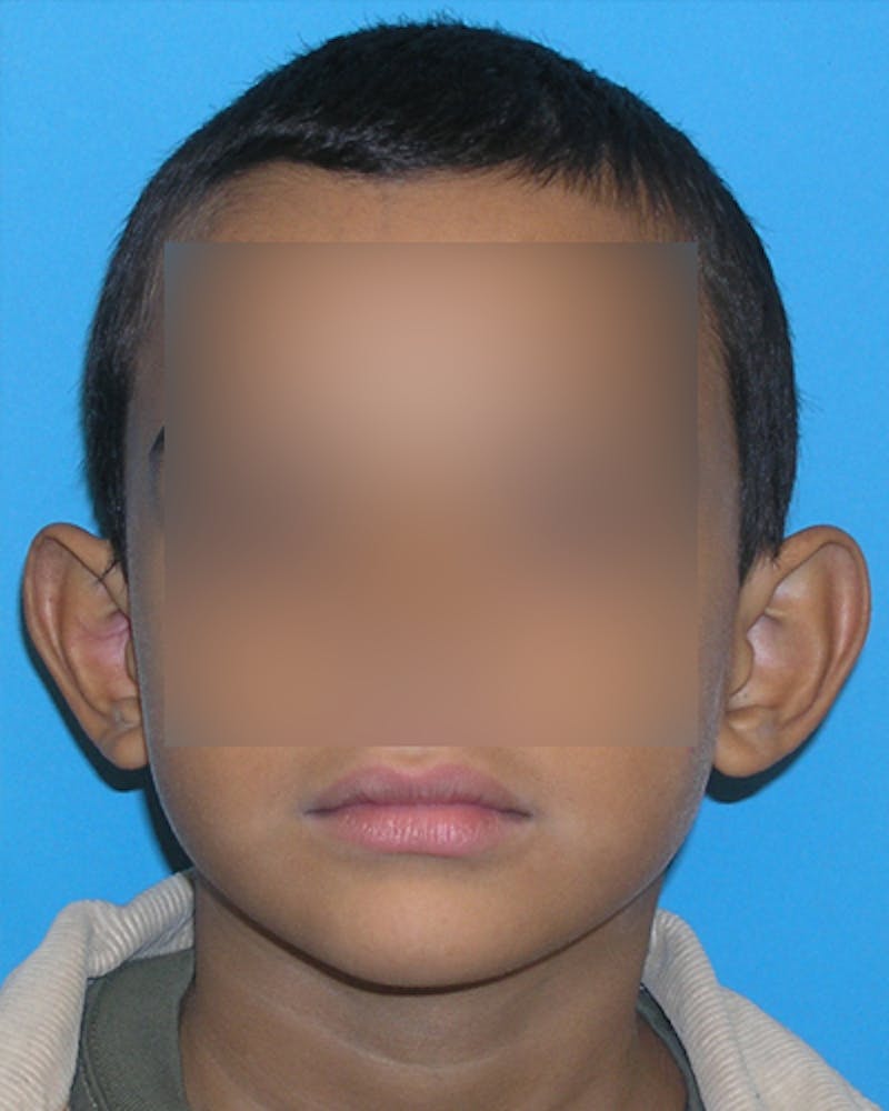 Patient Qt4mtL2PRvej2vnmCF7UlA - Ear Surgery (Otoplasty) Before & After Photos