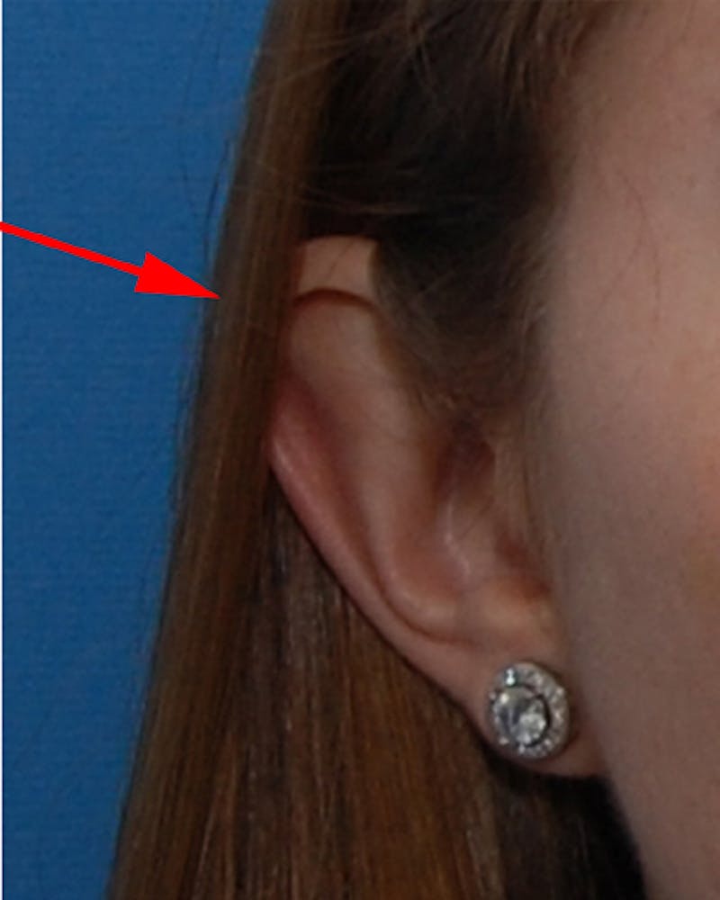 Ear Surgery Before & After Gallery - Patient 179884 - Image 3