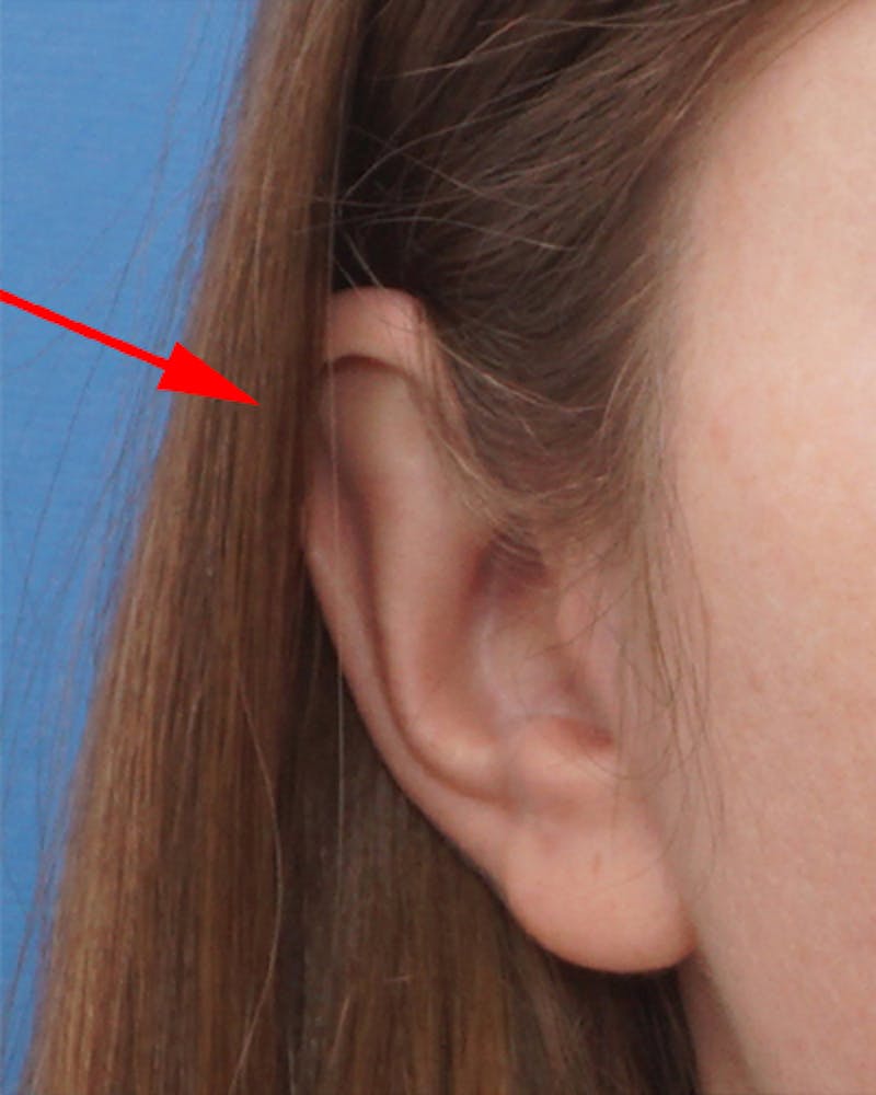 Patient F-dU9Zp7STeI0O8dsO_-sA - Ear Surgery (Otoplasty) Before & After Photos