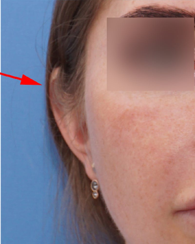 Ear Surgery Before & After Gallery - Patient 179884 - Image 4