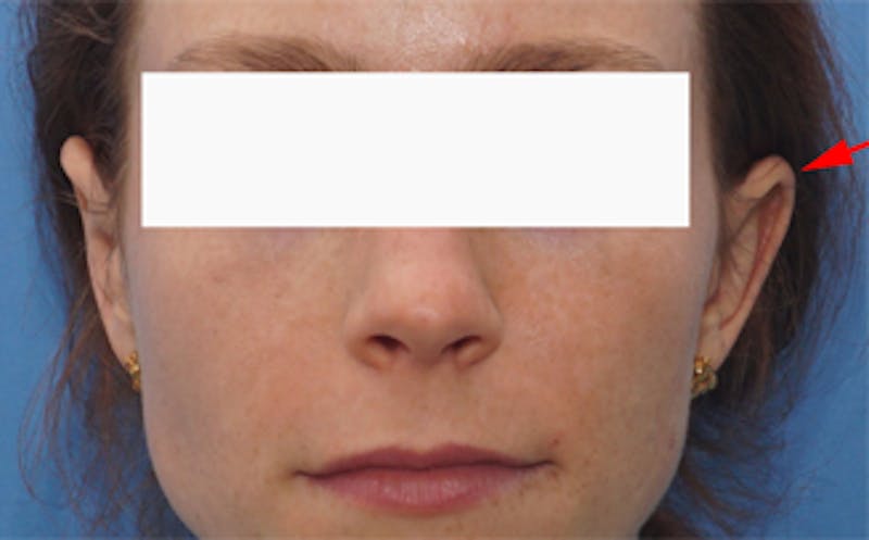 Patient QF38HkCQRG2r41WnNezHog - Ear Surgery (Otoplasty) Before & After Photos
