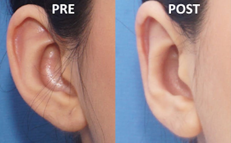 Ear Surgery Before & After Gallery - Patient 140817 - Image 4