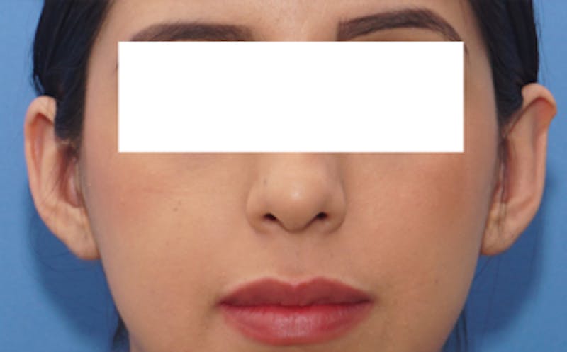 Patient JMbA2F1mRFajOCI7tc6y-A - Ear Surgery (Otoplasty) Before & After Photos